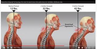 What type of bones make up the neck head and shoulder. Dropped Head Syndrome Isolated Neck Extensor Myopathy Caring Medical Florida