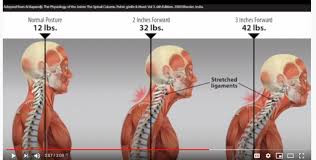 Where the rounded top of the arm bone (humerus) contacts the shoulder blade is. Dropped Head Syndrome Isolated Neck Extensor Myopathy Caring Medical Florida