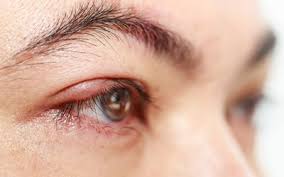 Dd was born with angel kisses on both eyelids as well as the classic . Causes And Relief For The Eyelid Twitch