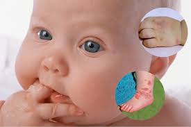 Trẻ bị tay chân miệng nên tắm lá gì để phục hồi nhanh?