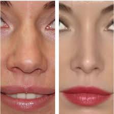 Nose Job To Fix Bulbous Nose Rhinoplasty Cost Pics Reviews Q A Rhinoplasty Cost Nose Job Cost Nose Job