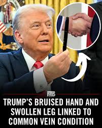 Trump's leg swelling and bruised hand? Turns out it's not deep vein drama.  Docs say it's a common condition called chronic venous  insufficiency—basically, his veins aren't pumping blood back up as well