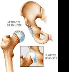 Comment bien faire l'amour ? Operation Prothese De Hanche Traitement Arthrose Prothese Totale Pth