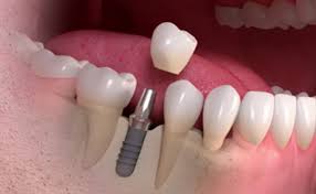 Maybe you would like to learn more about one of these? Cena Zubnych Implantatov