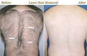 It's important to note that no documented cases of cancer or other devastating illnesses have been associated with laser hair removal at this point, but it's. Men Botox Laser Hair Removal Skin Care Minneapolis Mn