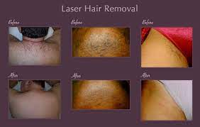 It is best to choose the right. Should I Get A Brazilian Laser Hair Removal