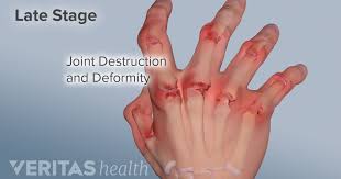 Hand Pain And Rheumatoid Arthritis Ra