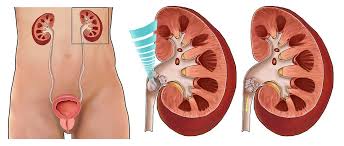 Extracorporeal Shock Wave Lithotripsy Eswl Health Travellers Worldwide Independent Health Advisory Medical Assistance Rescue Medical Travel Second Opinion Surgeries Abroad Teleclinics