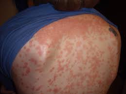 Is psoriases a word in the scrabble dictionary? Guttate Psoriasis Wikipedia