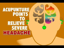 acupuncture points to relieve severe headache