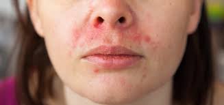 Image result for red rash face