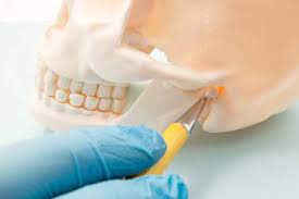 Is there anyone who personally went there for a revision? Insurance Covering Corrective Orthognathic Jaw Surgery