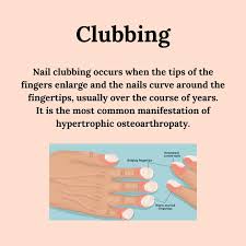 Image result for Clubbing nails feet