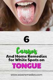 White Spots On Tongue Tongue Sores White Patches Treatment White Tongue