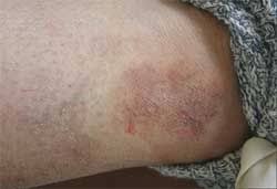 The sunlight contains harmful ultraviolet rays which is detrimental for the skin. Skin Disorders In Older Adults Vascular Lymphatic And Purpuric Dermatitides Part 1