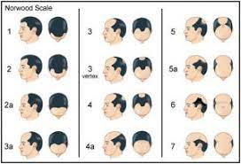 Male Hair Loss Vertex