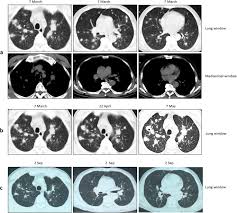 Thirteen patients (68.4%) were misdiagnosed as pneumonia, lung cancer and tuberculosis initially. Misdiagnosis Of A Multi Organ Involvement Hematogenous Disseminated Tuberculosis As Metastasis A Case Report And Literature Review Infectious Diseases Of Poverty Full Text