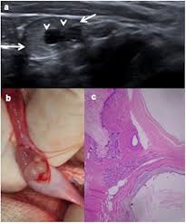 Sometimes, you may notice a lump or size change in one of your testicles. Testicular Tumours In Children An Approach To Diagnosis And Management With Pathologic Correlation Insights Into Imaging Full Text