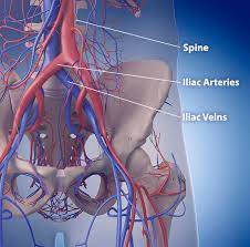 May Thurner Syndrome Cardiovascular Institute Of The Shoals