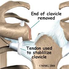 Image result for SC Dislocation