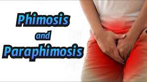 Image result for Paraphimosis