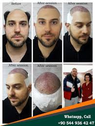 Dr Zen Hair Clinic Olcay Saygin 2020