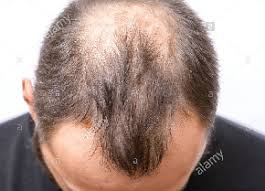Vitamin aencourages healthy production of sebum so wearing a scarf/ bandanna over your hair or a terry cloth headband can prevent hair loss. Say Goodbye To Baldness Four Tips To Prevent Hair Loss South Florida Caribbean News