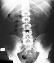 Image result for Neutropenic Colitis