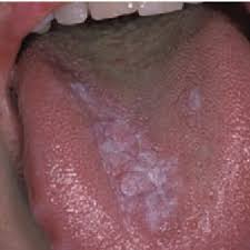 Image result for lichen planus on tongue)