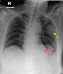 Image result for lung cancer xray
