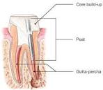 Image result for when do i need root canal treatment