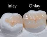 Inlays and Onlays - Brushwell Dental & Implants