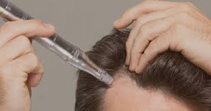 Preparing for microneedling at home download article. Microneedling For Hair Loss Myhair