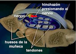 Check spelling or type a new query. Cirugia Endoscopica Para El Tunel Carpiano