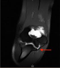Find symptoms,causes and treatments of hand disease.for your health. Ulnar Collateral Ligament Injuries Of The Elbow In Female Division I C Oajsm
