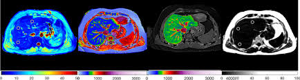 Start studying health unit 8. A Composite Biomarker Using Multiparametric Magnetic Resonance Imaging And Blood Analytes Accurately Identifies Patients With Non Alcoholic Steatohepatitis And Significant Fibrosis Scientific Reports