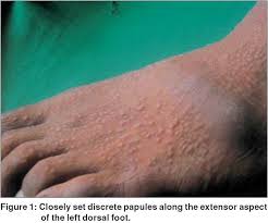 Image result for Papular Acrodermatitis