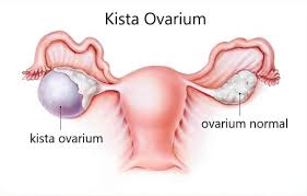 Kista Ovarium