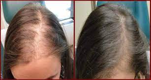 Prp Hair Restoration New Jersey Hair Loss Treatments Rutherford