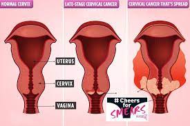 Cervical cancer starts in the cervix. The 5 Early Signs You Could Have Silent Killer Cervical Cancer After Millions Skip Smear Tests