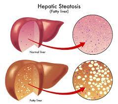 Liver Cirrhosis Secondary To Nash Icd 10