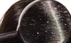 Sac Sorunlarindan Bir Tanesi Sac Derisinde Olusan Ve Kotu Bir Goruntuye Sebep Olan Kepektir Gunluk Yasamda Sactak Dandruff Face Makeup Tips Round Face Makeup