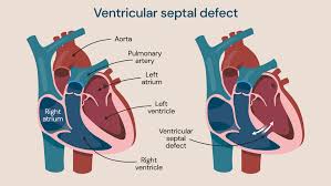 Image result for Ventricular Septal Defect