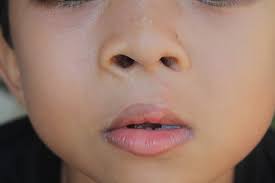 Image result for Cleft Lip