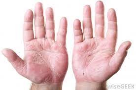 Primary or physiologic pe can be due to heredity, occurs in at least 30% of pregnant women as a result of associated alterations in the function of the skin and its microvasculature. What Are The Different Treatments For Palmar Erythema