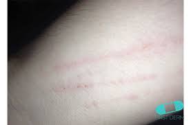 Image result for Dermatographism