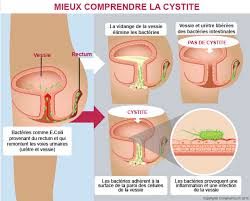 Elle est évacuée du corps par les urines odorantes sont parfois dues à une infection, aux fortes chaleurs ou à la consommation de certains aliments tels que le chou, l'ail et l'asperge. Infections Urinaires Symptomes Traitements Creapharma