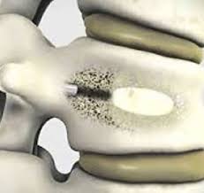 Image result for Vertebral Compression Fracture