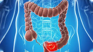 The early stages of colon cancer usually don't have any signs or symptoms. What You Need To Know About The Stages Of Colon Cancer Gastroenterologist San Antonio