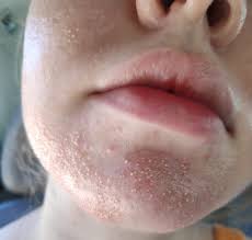However, it may return if the conditions causing the fungal infection are not prevented. From Fungal Acne Folliculitis To Clear Skin With Pictures Skin Careless